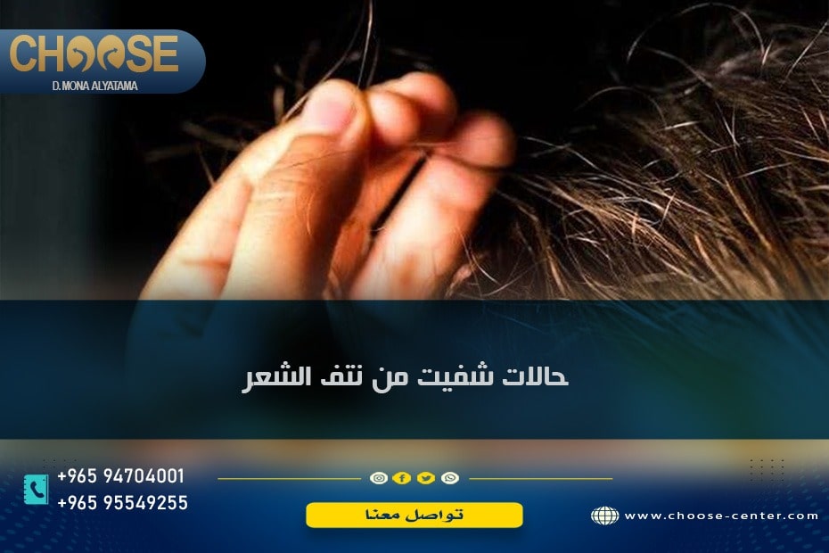 حالات شفيت من نتف الشعر